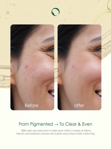 Anti Pigmentation Serum